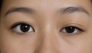 Jangan Abaikan Ptosis, Kelopak Mata Jatuh Bukan Sekadar Isu Kecantikan